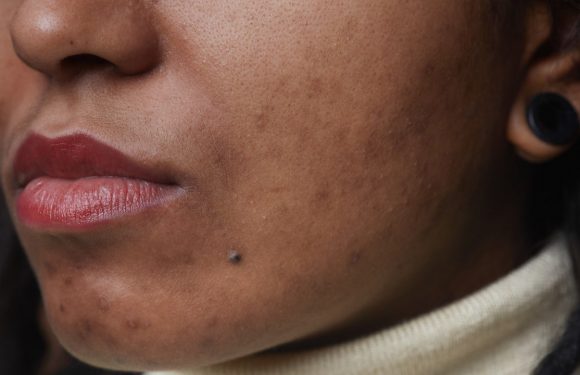 How to Treat Acne and Post-Acne Marks on Dark Skin, According to a Dermatologist — See Video