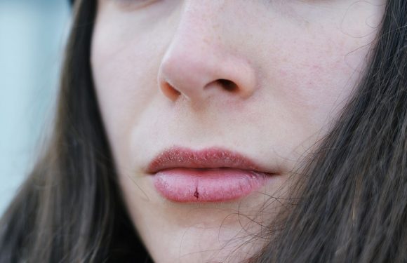 How to Get Rid of Chapped Lips — Expert Tips and Recommendations