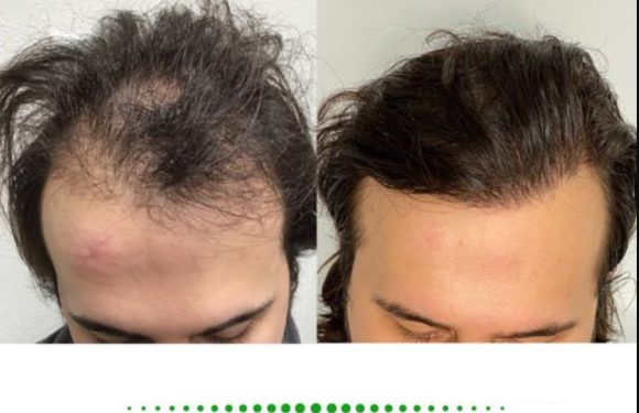 Hair Transplant Surgery: Types, What to Expect, Costs, Photos and More.