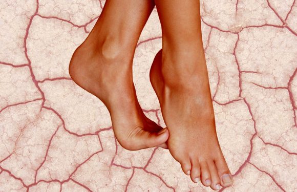 How to Care for Dry, Cracked Heels in 2023 — Expert Advice