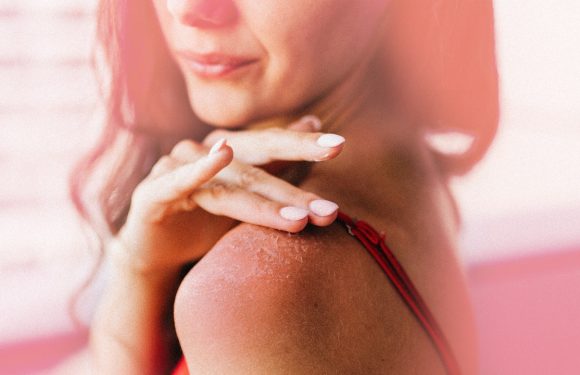 Why Sunburn Peeling Is Both a Good and Bad Thing for Your Skin