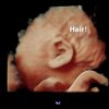 Curly Hair On 3D Ultrasound