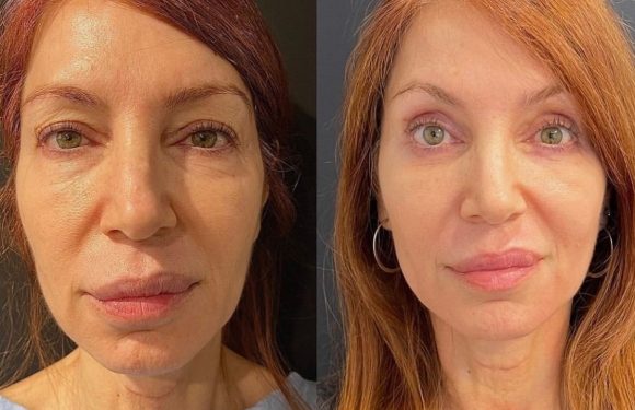 Blepharoplasty: The Eyelid Lifting Procedure Is on the Rise — But Is it Safe?